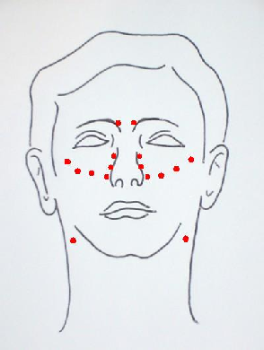 DIAGRAM of points to prick in cases of RHINITIS, SINUSITIS and ANGINA