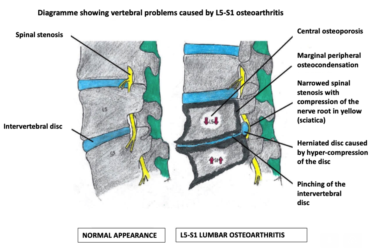 Sketch of the alterations causing lumbar osteoarthritis